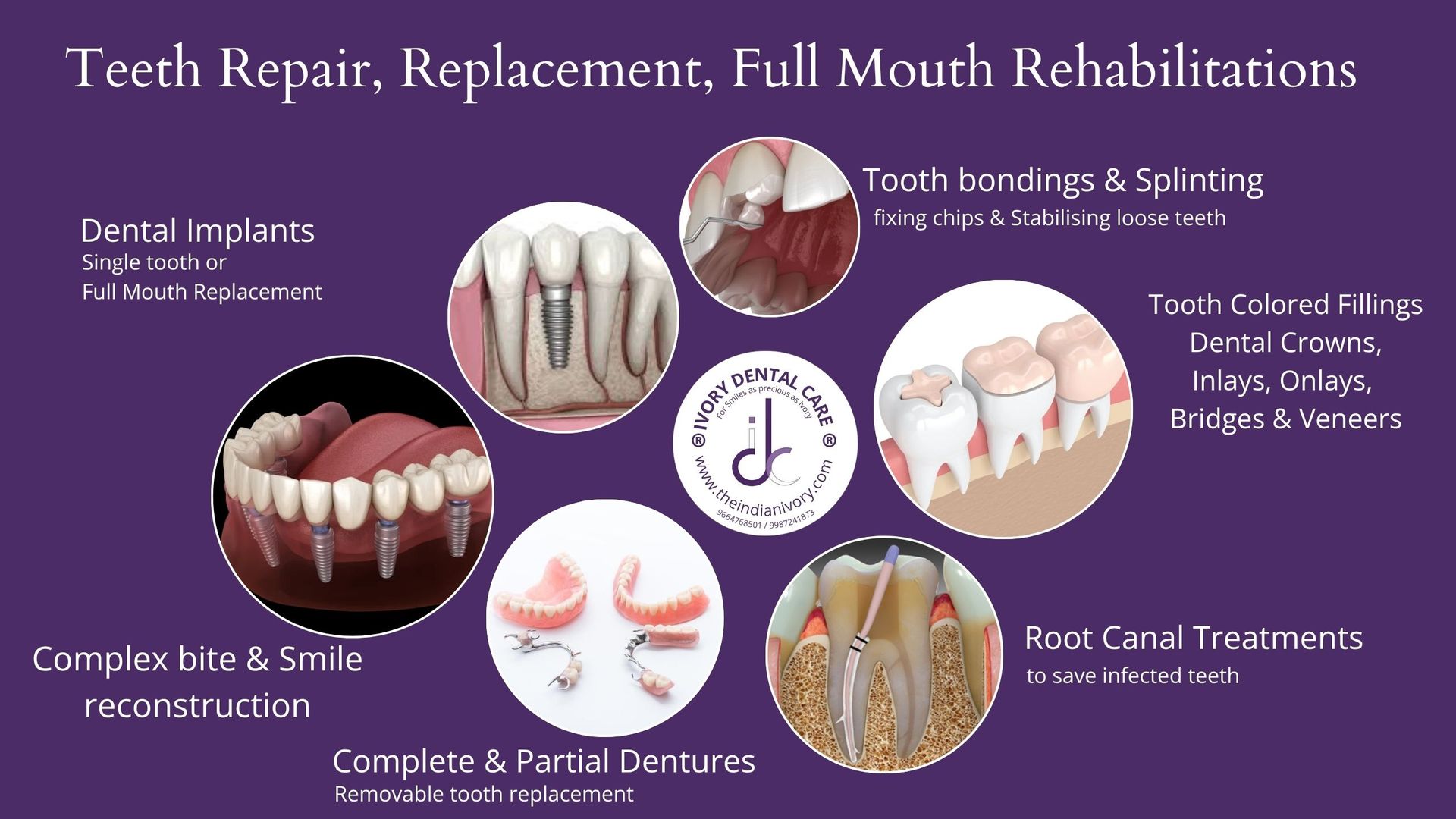 root canal treatment in mumbai dental implants in yari road andheri west